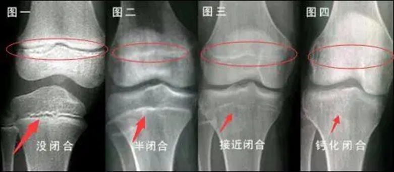 有一种遗憾叫“就差1厘米”，8~14岁孩子请抓住最后长高机会！(图2)